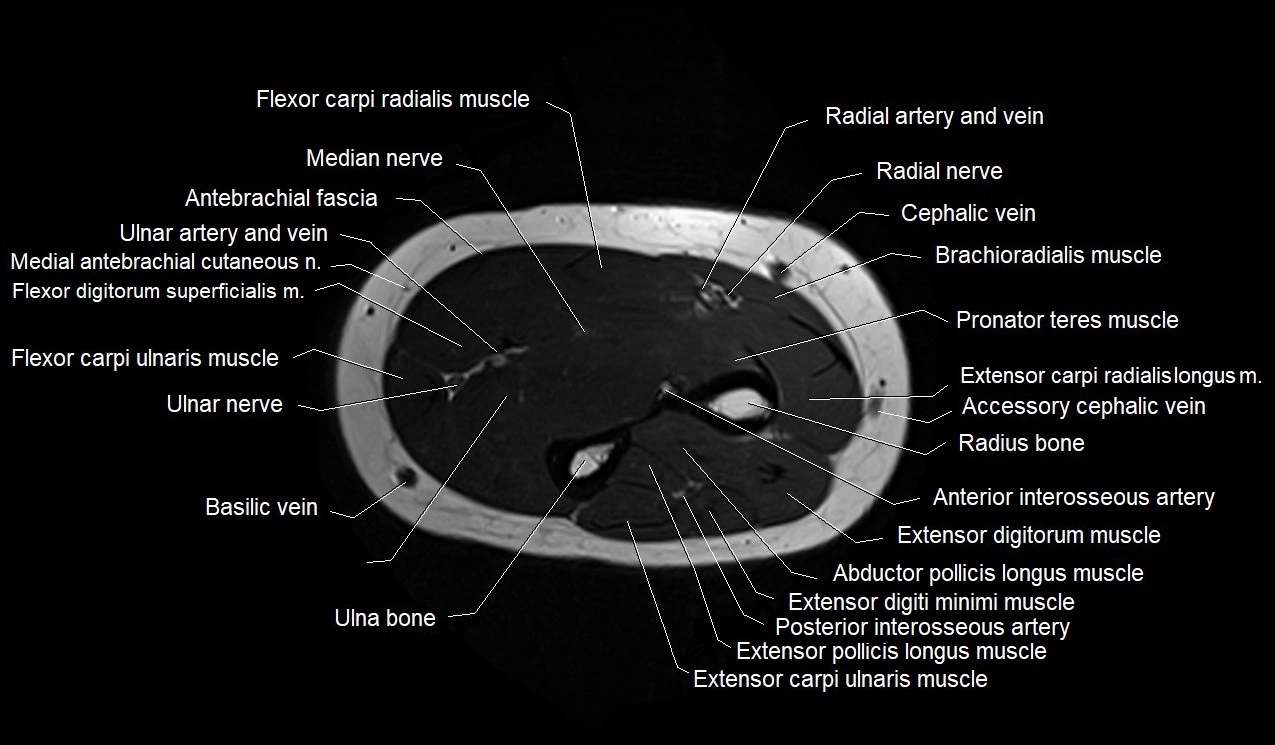 MRI 3T forearm axial cross sectional anatomy image 24.webp